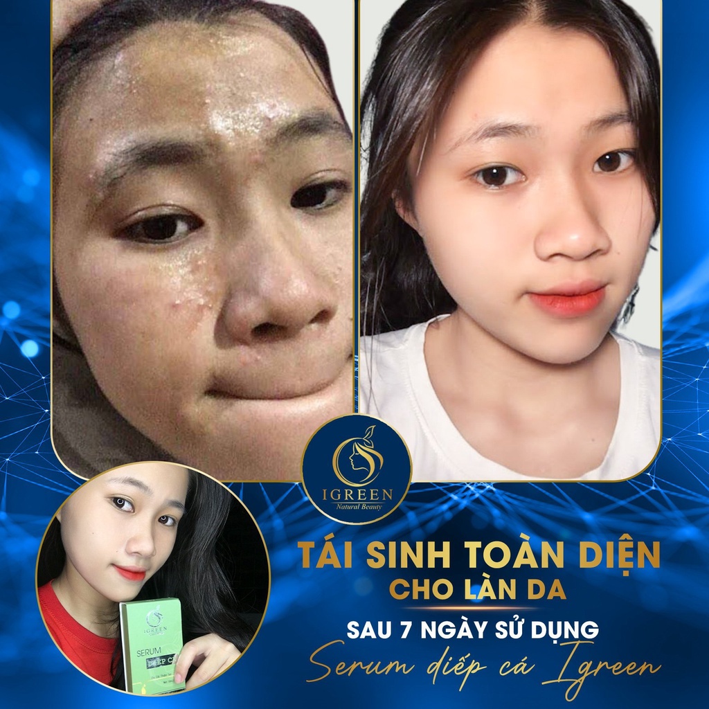 Serum diếp cá, serum diếp cá Igreen 10ml sạch mụn thâm se khít lỗ chân lông, nuôi dưỡng da căng bóng mịn màng