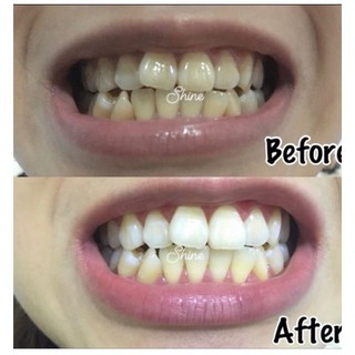 Gel trắng răng -ECO WHITENING GEL PLUS PEN