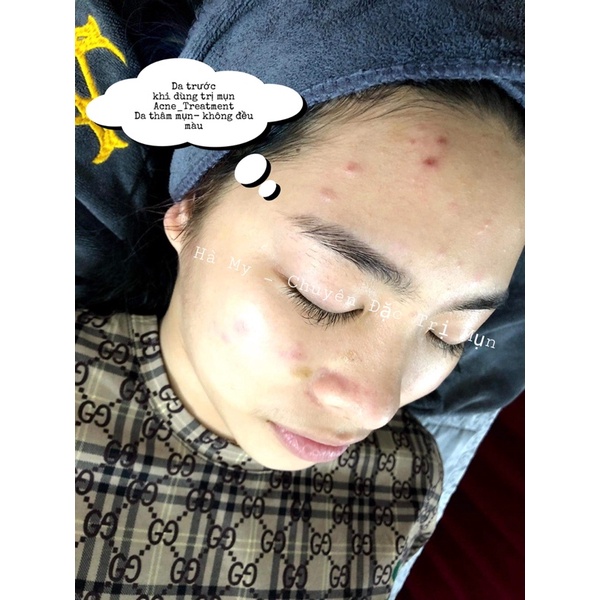 ACNE TREATMENT ( Tặng Kèm Que NẶN MỤN ) | BigBuy360 - bigbuy360.vn