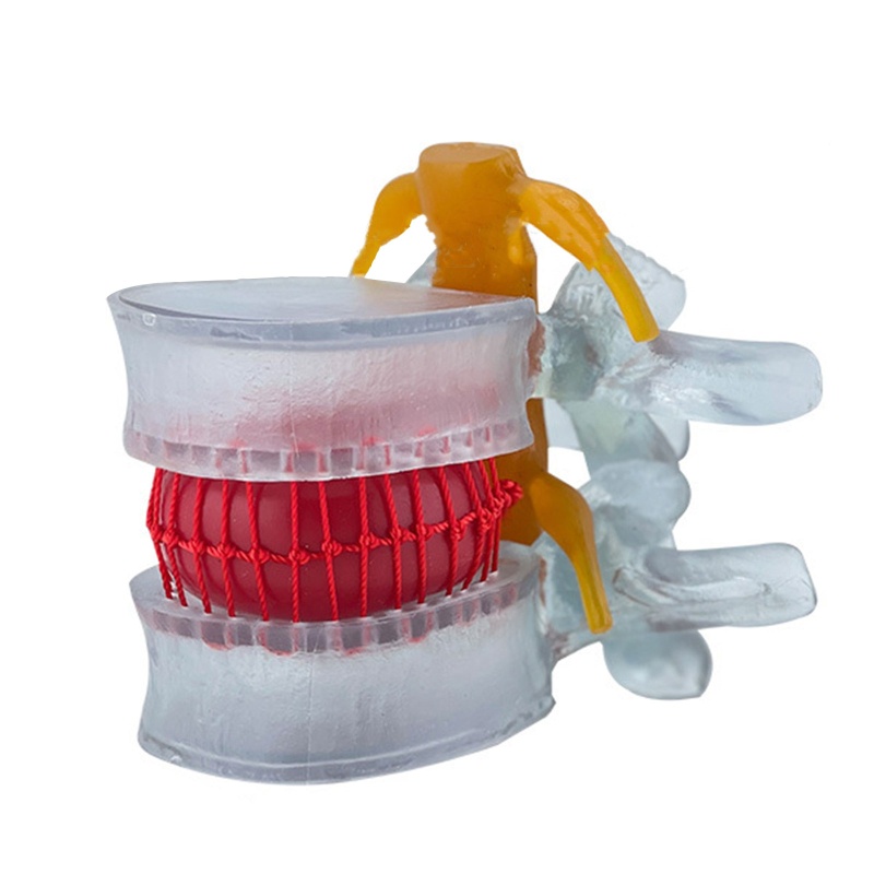 Blg Đĩa Mô Hình Di Sản Đĩa Thắt Lưng Có Thể Di Chuyển Được Di Chuyển Được Cho Lối Đi Đường Đi Thông Thường Và Ner