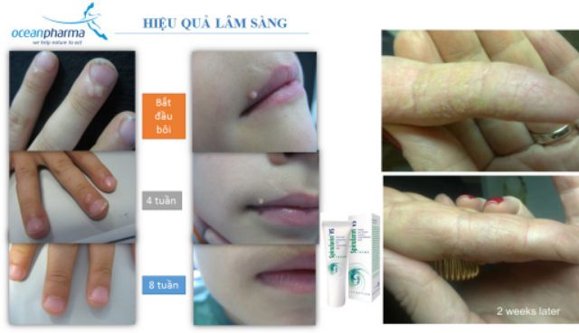 KEM GIẢM MỤN CÓC MỤN THỊT SPIRULARIN VS CREAM 10ml