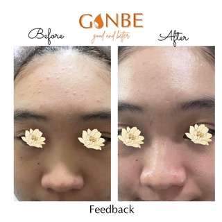 TINH CHẤT CHẤM MỤN