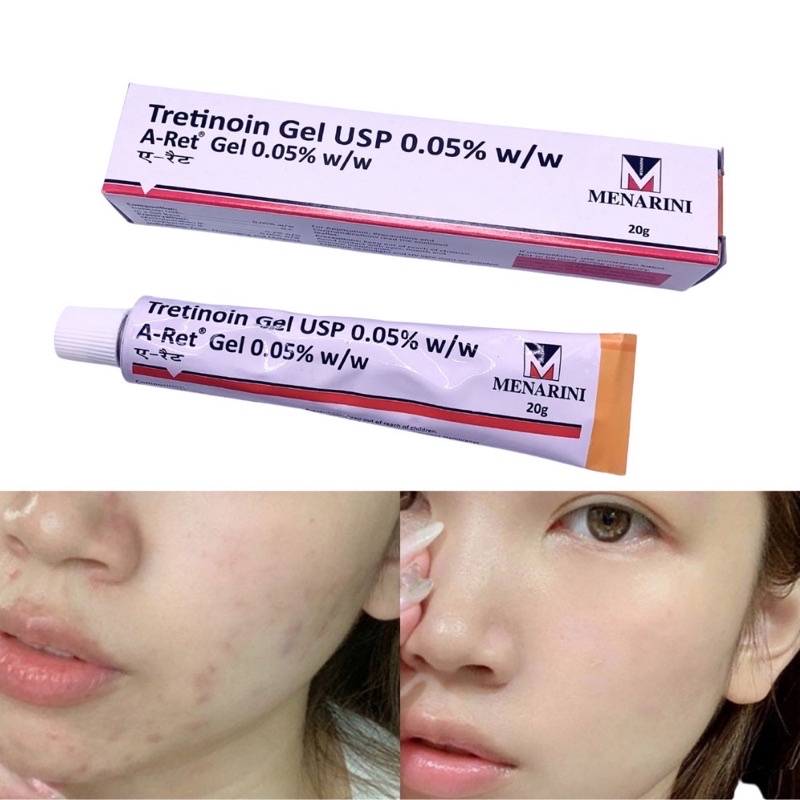 Gel dưỡng giảm mụn, chống lão hóa da Tretinoin Aret Ấn Độ 20g