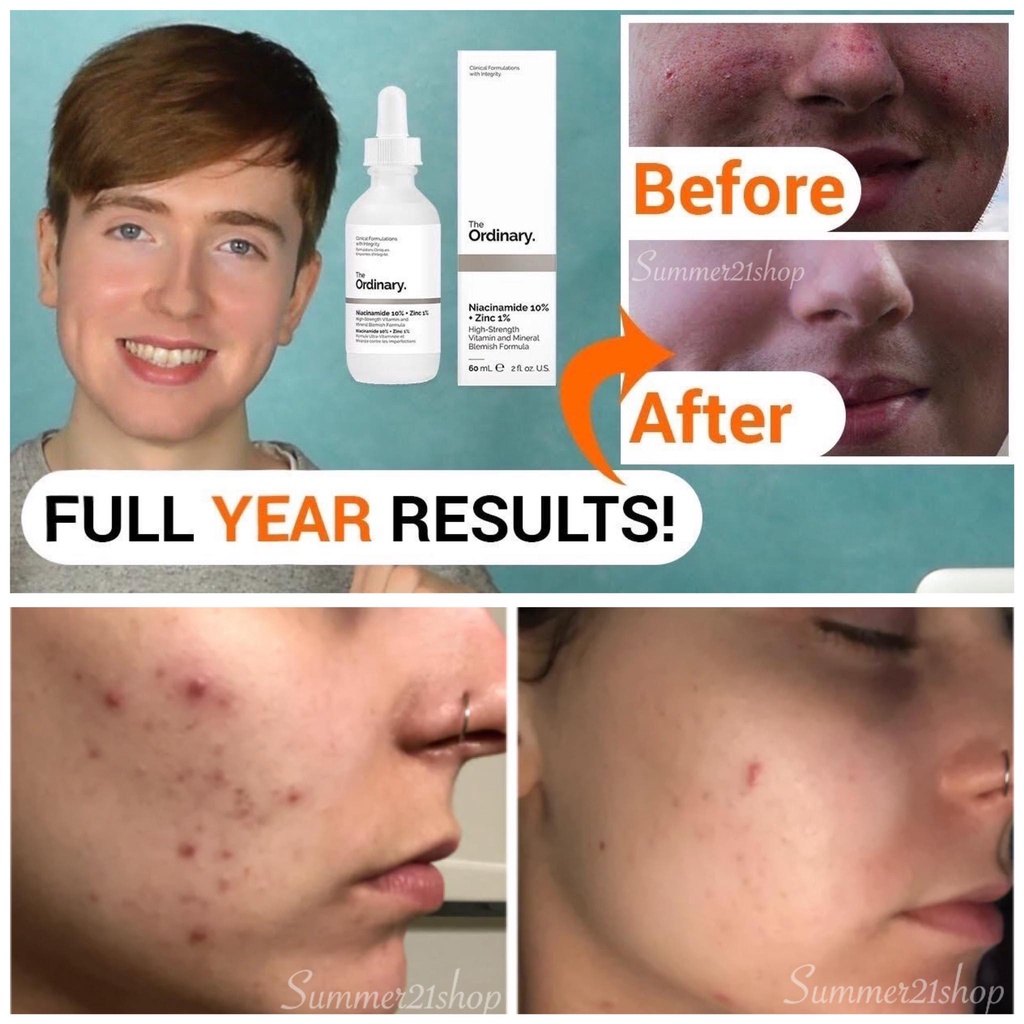 Tinh Chất Ngừa Mụn, Sáng Da, Cân Bằng Bã Nhờn, Thu Nhỏ Lỗ Chân Lông The Ordinary Niacinamide 10% + Zinc 1%