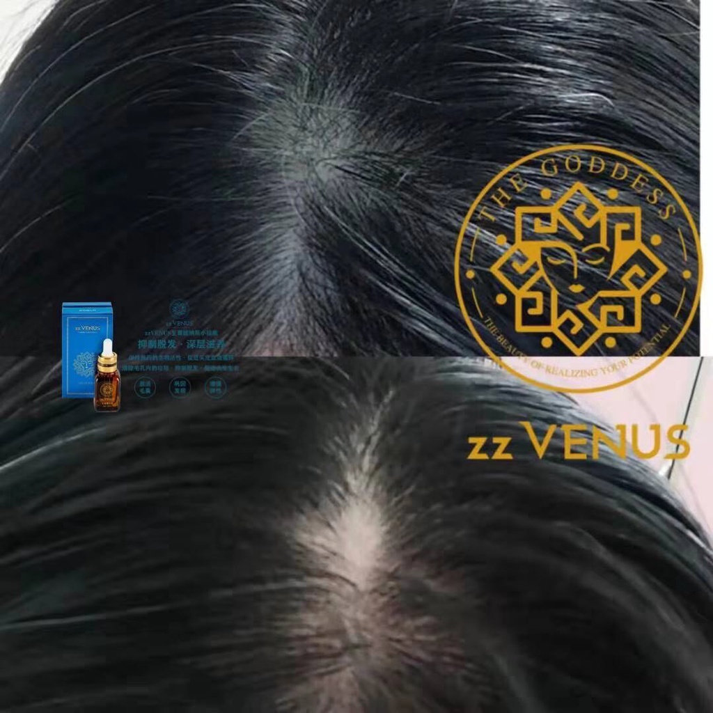 [Chính Hãng] Serum Kích mọc tóc King Venus SR001 100% Thiên nhiên Kích tuần hoàn máu mọc tóc con ngăn ngừa gãy rụng