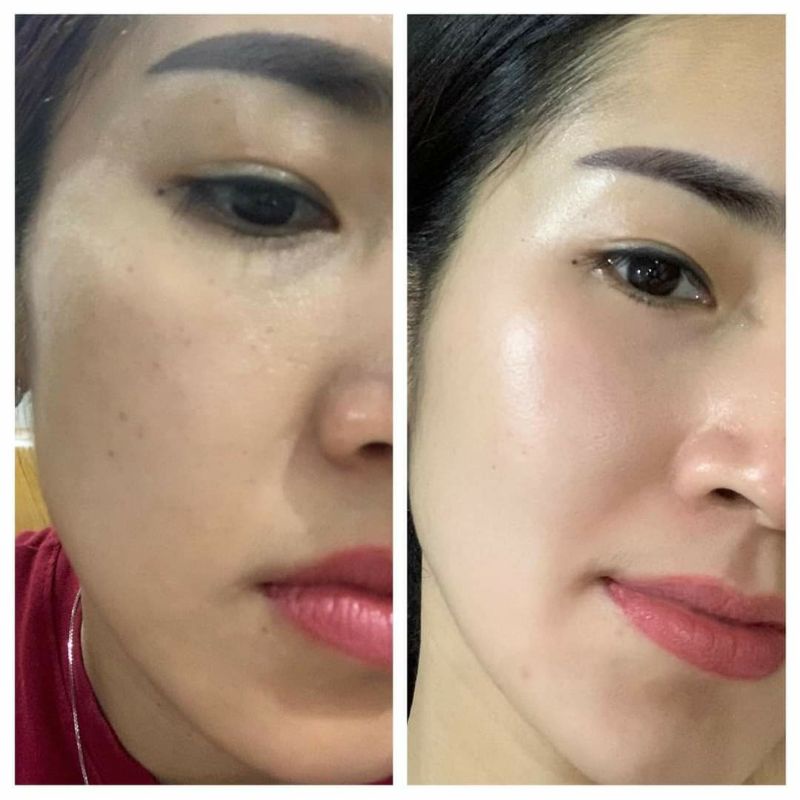 Kem nám Cosmelan2 - Chuyên về nám mảng ,nám chân sâu , đốm nâu , tàn nhang , đồi mồi , da không đều màu