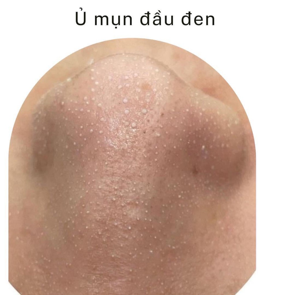 Ủ mụn đầu đen Remove BlackHeads / Remove BlackHead ONMACABIM