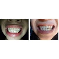 (A1+A2) Dụng cụ niềng răng cho trẻ em