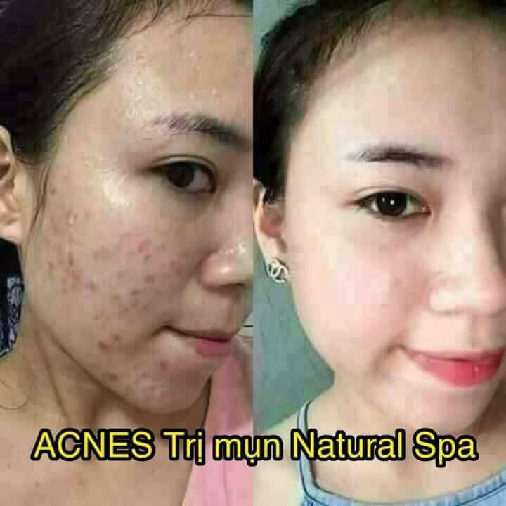 Kem Ngăn Ngừa Mụn Acne Dr Cell