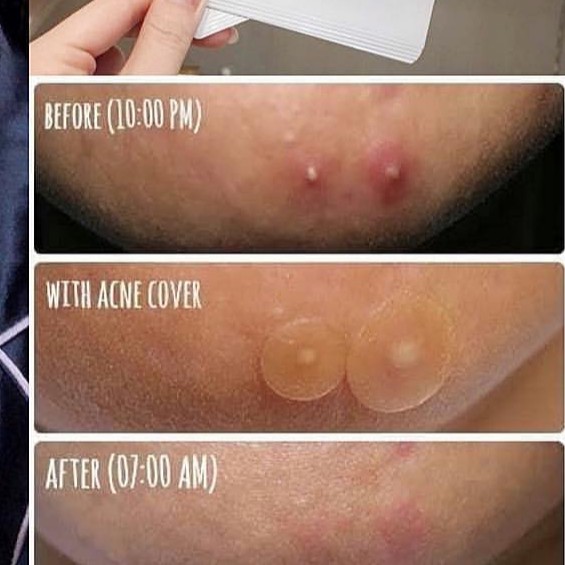 Miếng dán giảm mụn cấp tốc Some By Mi Acnes Clear Patch gói 18 miếng.