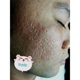 PEEL TCA SÉT NHỎ CHẤM RỖ, THÂM, TÀN NHANG, ĐỒI MỒI