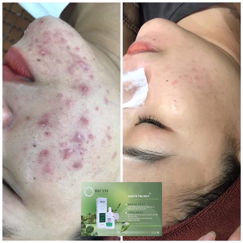 Serum mụn Bicos