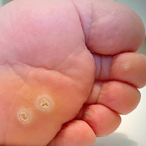 Mụn Cơm, Mụn Cóc, Mắt Cá Chân, Vết Chai Sần Acid Trivhloracetic 80% - Sống Chất 24h | BigBuy360 - bigbuy360.vn