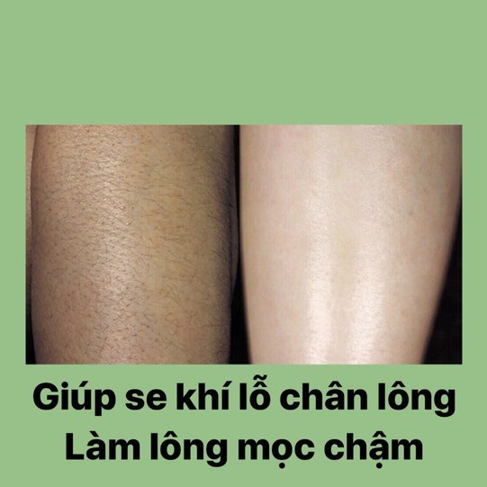 MỠ TRĂN TRIỆT LÔNG VĨNH VIỄN ( TOÀN BODY TAY, CHÂN, NÁCH, BIKINI ) | BigBuy360 - bigbuy360.vn