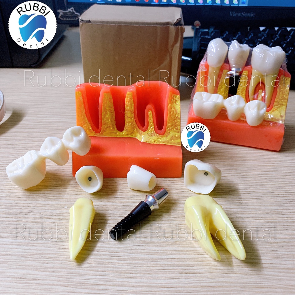 Mô hình tư vấn Implant, cầu 3 răng dùng trong Nha khoa