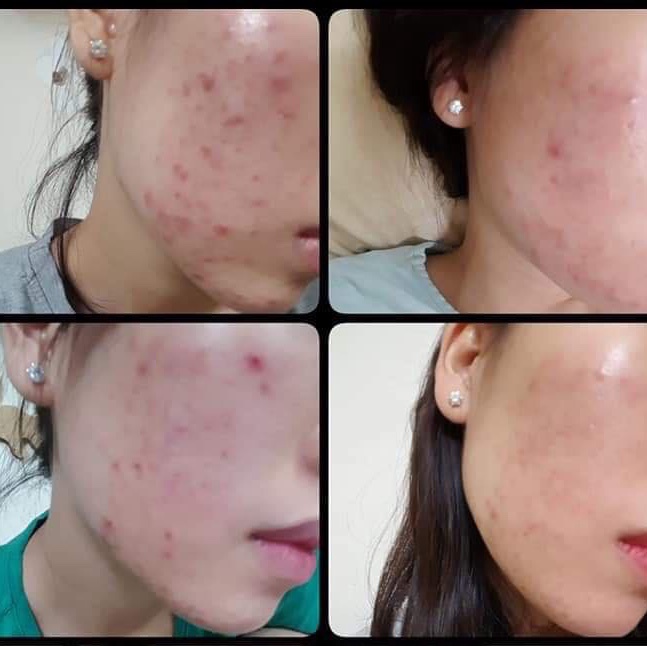 Kem dưỡng Bielenda Green Tea- Trà xanh kiềm dầu, giảm mụn, thâm/ngừa mụn, phục hồi, trẻ hoá da