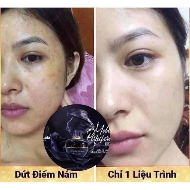 (HÀNG CHÍNH HÃNG 100%) COMBO SERUM JIUHE  THANH TÔ VÀ CAO NÁM BALLA LUTA