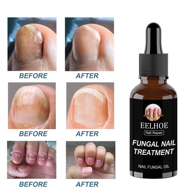 Eelhoe Nail Repair Serum Chân Sửa Chữa Tinh Chất Gel Loại Bỏ Nấm Sơn Móng Tay 30Ml/50Ml Sản Phẩm Chăm Sóc Móng Wine01