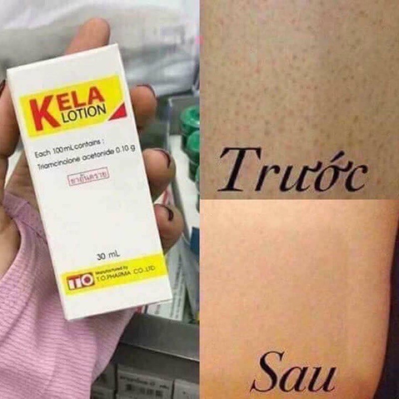 Kela Lotion Viêm Nang Lông Thái Lan 🇹🇭