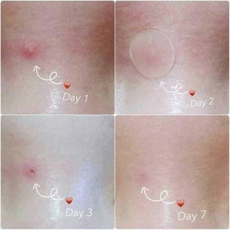 Miếng dán mụn viêm, mụn sưng, mụn bọc, mụn mủ Mediheal A Zero Shot Trouble Dressing Spot Patch LOVESKINCARE VN