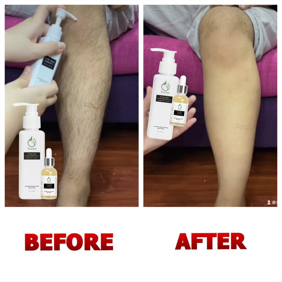 Combo Kem tẩy lông và serum ức chế mọc lông dùng cho Chân, Tay, Nách, Ngực, Bụng, Body tại nhà SUZIKO