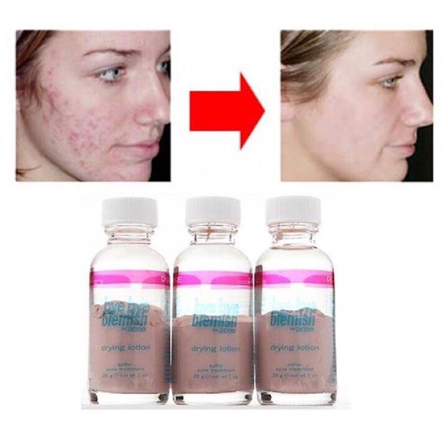 Lottion chấm mụn Bye bye blemish - Mỹ