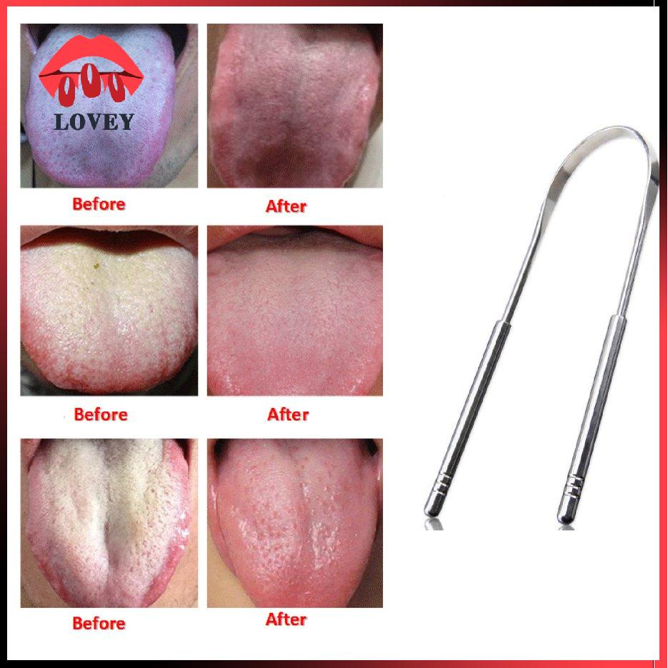 lovey★U-Shaped Tongue Scraper Tongue Cleaning Brush Stainless Steel Tongue Scraper