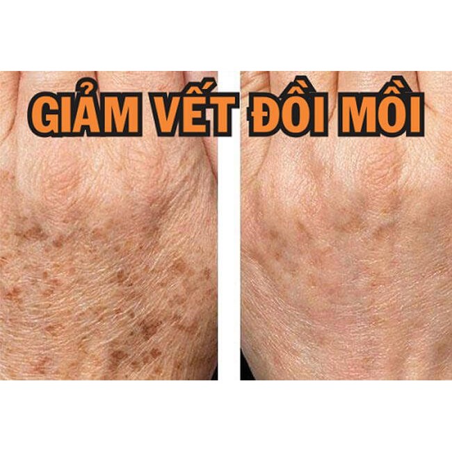 Kem Ngăn Ngừa Và Làm Mờ Nám Achromin 45g