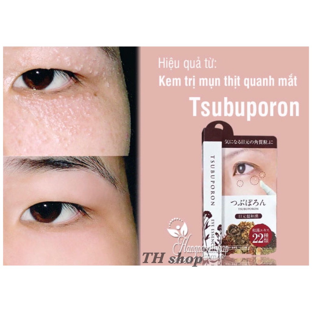 Bút MỤN THỊT quanh mắt Tsubuporon Nhật Bản 1.8ml dùng cho mụn thịt mụn cơm các vết sần sùi