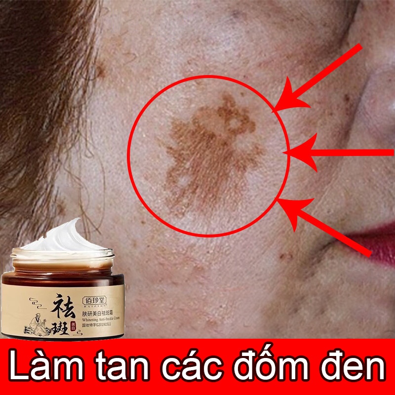 Kem Nám Tàn Nhang Kem trắng da mặt Dưỡng ẩm da mặt 30g mờ nám tàn nhang đồi mồi dưỡng ẩm làm trắng da bảo vệ