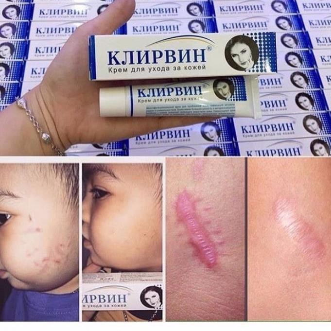 Kem bôi sẹo lồi Klirvin chính hãng Của Nga Kjinpbnh 25Gram  - HAVU Beauty