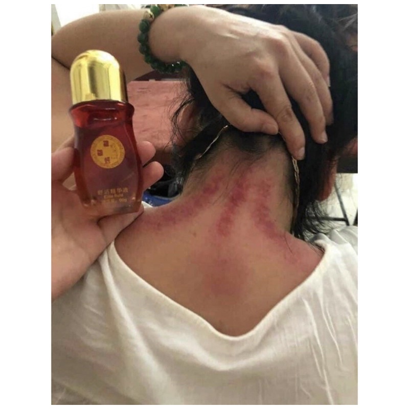ĐẦU NÓNG CẠO GIÓ ĐẢ THÔNG KINH LẠC (CỔN CỔN THÔNG)