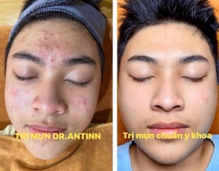 Serum DrAntin | khánh sinh tươi