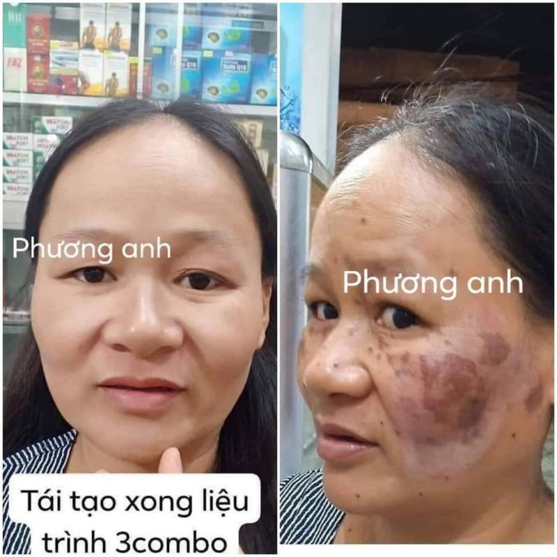 combo tái tạo da phương anh