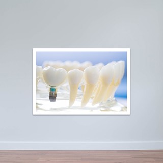 Tranh nha khoa “Mô hình răng” | Tranh treo tường phòng răng T3362
