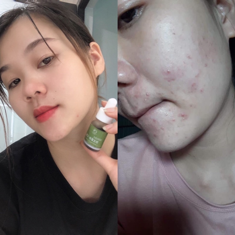 Serum Diếp Cá GIẢM MỤN, GIẢM THÂM, SE KHÍT LỖ CHÂN LÔNG, SÁNG DA - Serum Diếp Cá IGREEN | BigBuy360 - bigbuy360.vn