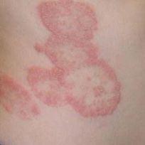 Kem bôi _dalieu . nấm ngoài da, á sừng ...khó chịu