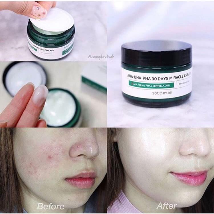 Kem Dưỡng Trị Mụn Some By Mi AHA-BHA-PHA 30 Days Miracle Cream (50ml)