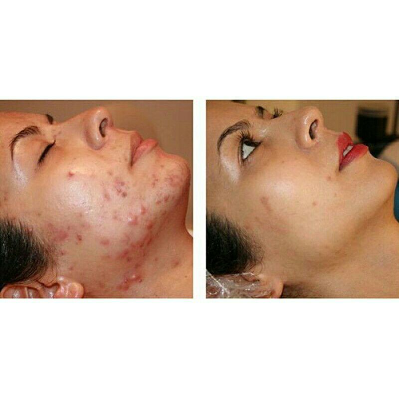 Bôi ngoài da Hiteen bôi mụn(10g) | BigBuy360 - bigbuy360.vn