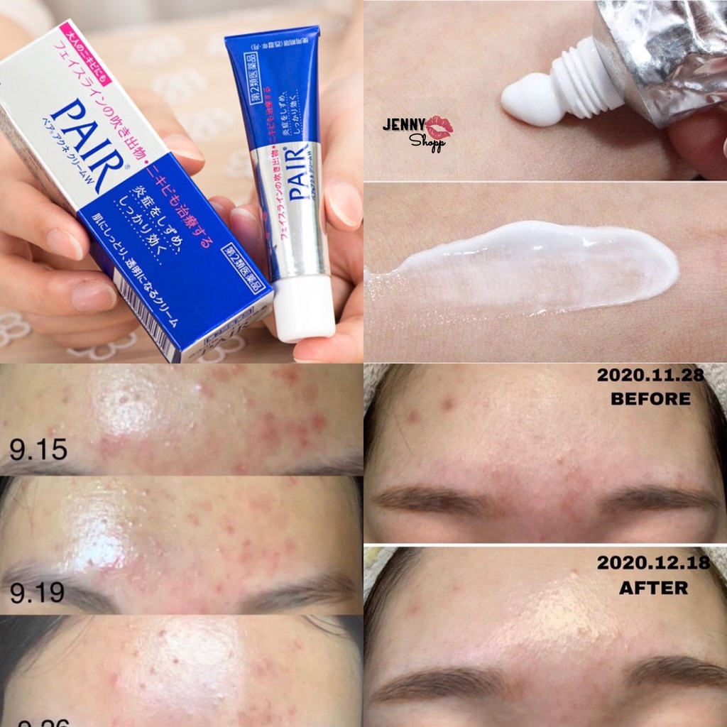 Kem Giảm Mụn Pair Acne W Cream Nhật Bản