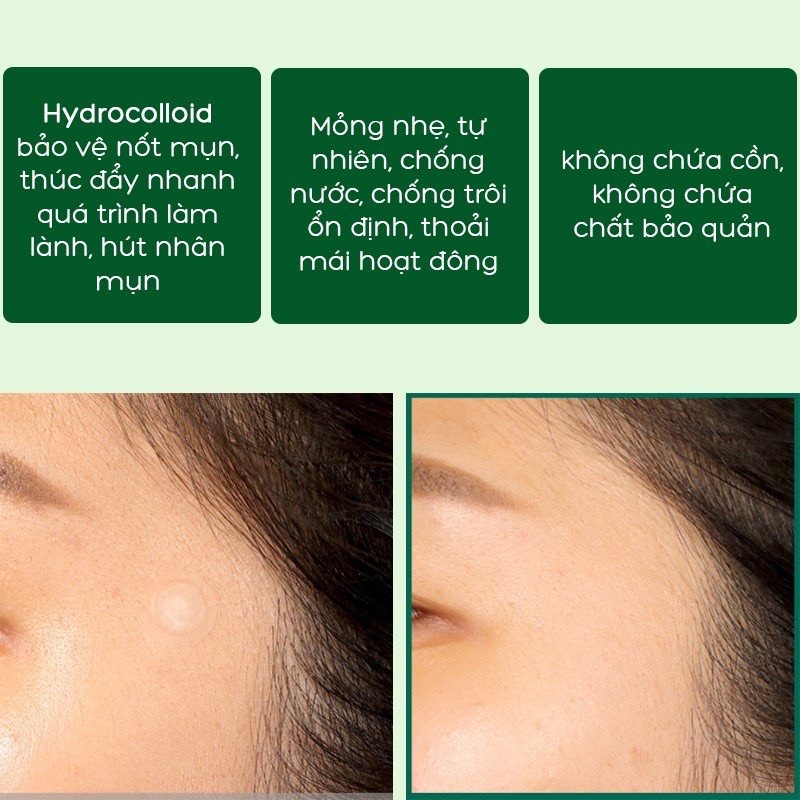 Miếng dán mụn Some By Mi Acnes Clear Patch