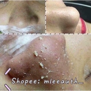 Miếng đẩy mụn đầu đen Goodbye Blackhead Ciracle