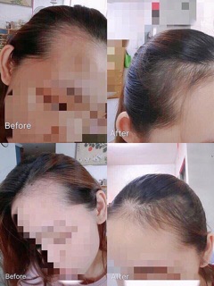 Thuốc bôi mọc tóc thảo dược sato nhật
