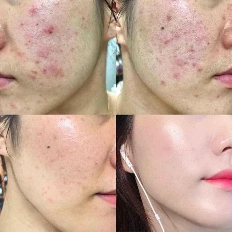 Serum Clenzi Đánh Bay Các Loại Mụn Và Thâm