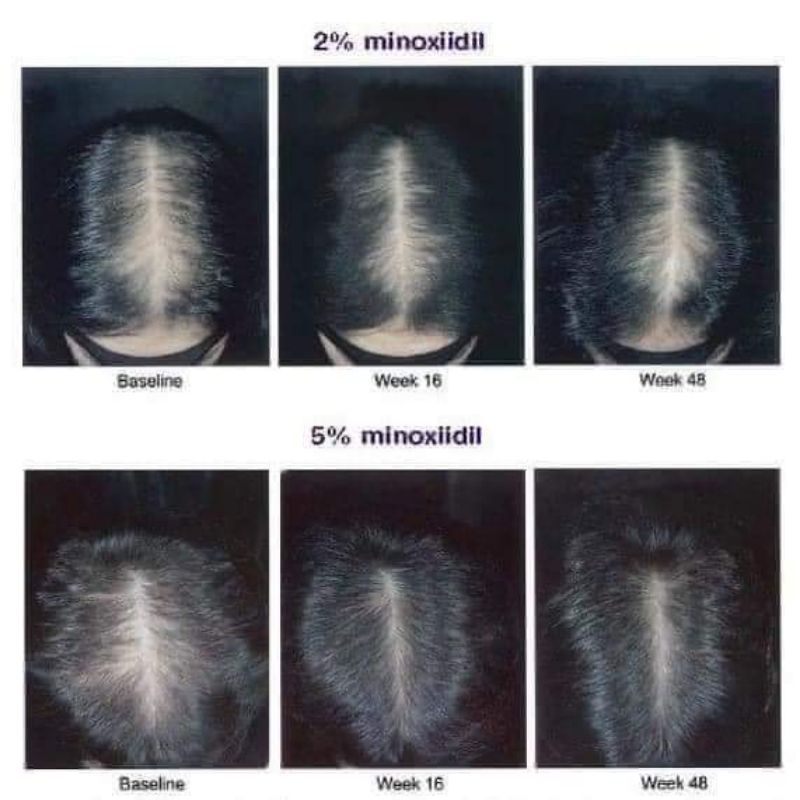 Xịt Mọc Tóc Minoxidil 2% và 5% Bailleul nội địa Pháp giúp tóc mọc nhanh và giảm rụng tóc
