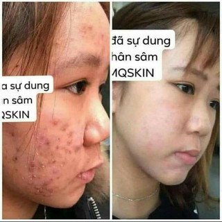 Nhân Sâm Thay Da MQ SKIN 80ml