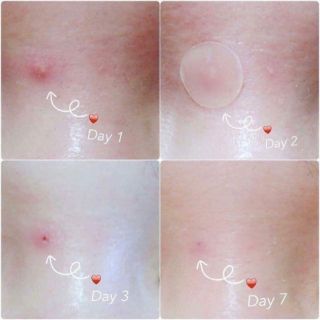 🐝🐝MIẾNG DÁN MỤN OLIVE YOUNG MẬT ONG 🐝🐝
