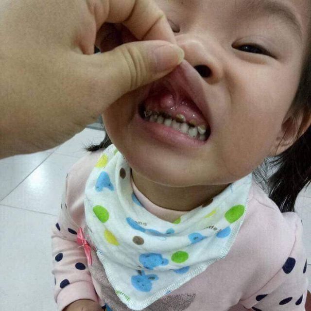 Chữa sún răng ở trẻ nhỏ