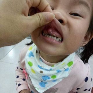 Chữa sún răng ở trẻ nhỏ
