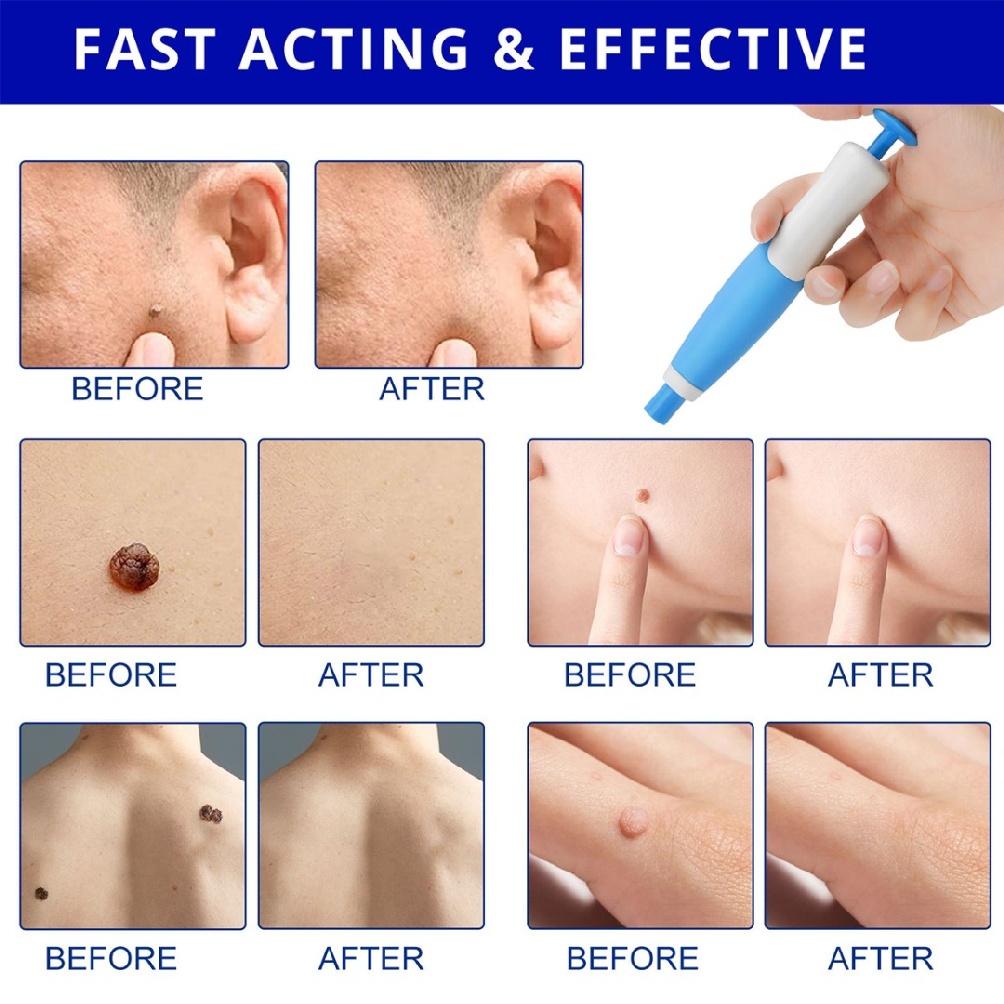 Bộ dụng cụ tẩy mụn thịt 2 trong 1 2-8mm an toàn không tổn thương